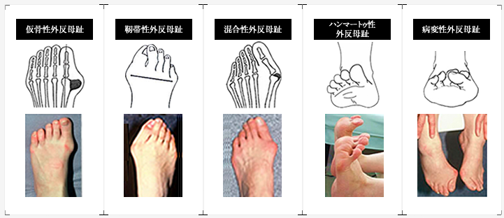 外反母趾の非外科的治療
